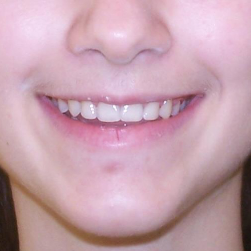patient after wearing braces