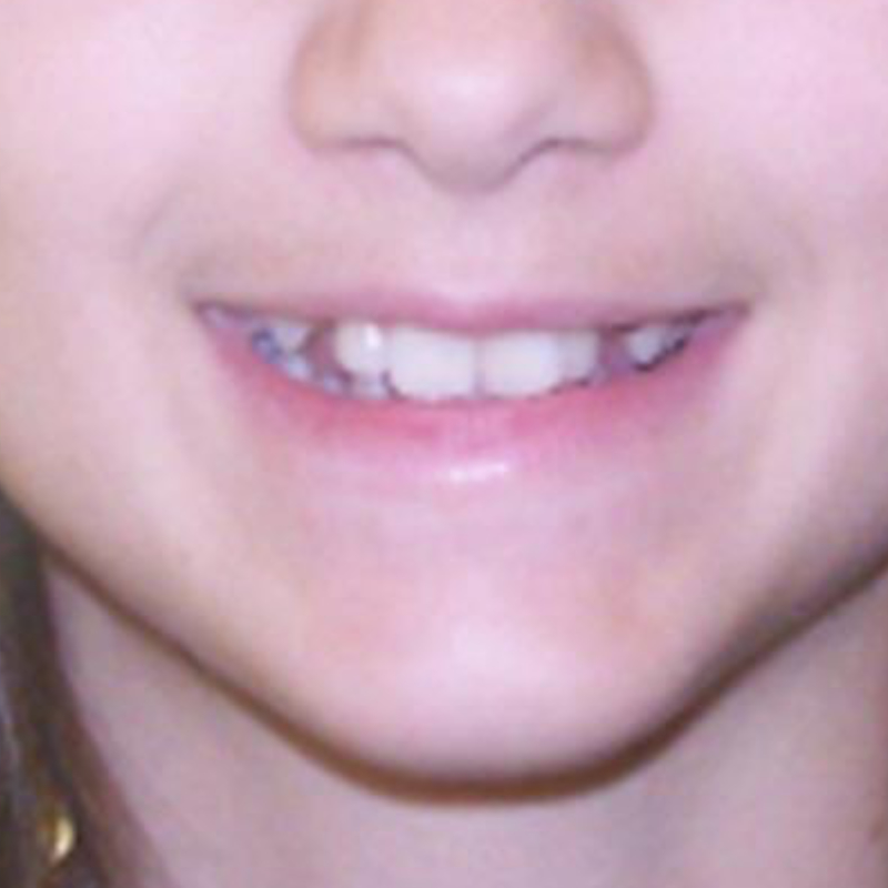 patient wearing braces